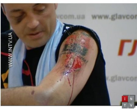 Освобожденный из плена шахтер: татуировку "Слава Украине!" срезали разбитой лампочкой