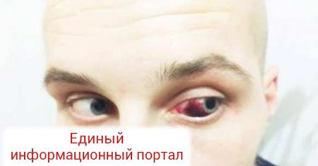 Херсонский политик откусил половину уха главе отделения Гражданского корпуса «Азов» (ФОТО)